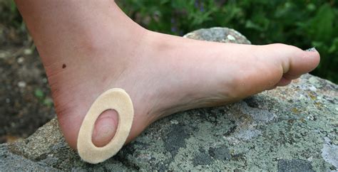 blood blister  skin  foot sale emergencydentistrycom