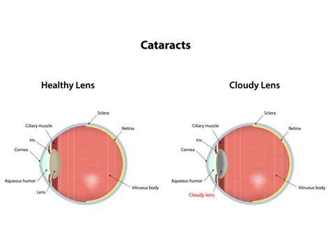 Cataract Surgery East Alabama Eye Clinic