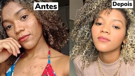 Como Acabar E Se Livrar De Todas As Espinhas Acne Do Corpo Youtube