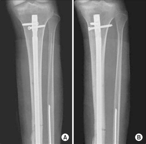 An Intramedullary Nail With Oblique Interlocking Screws The Length Of