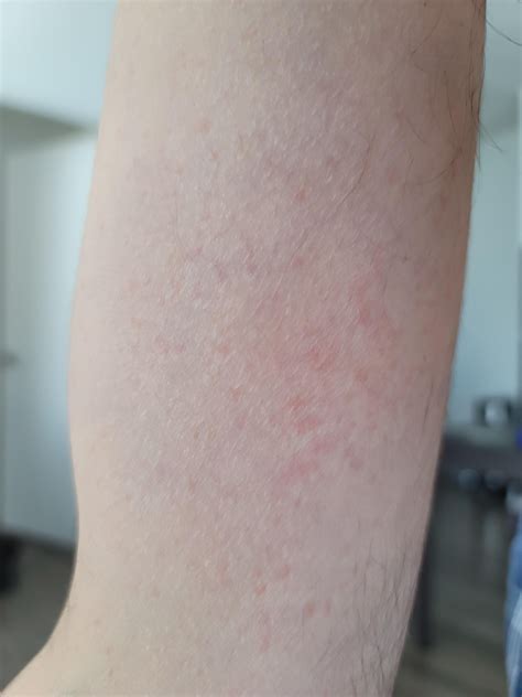 sudden burning sensation and red dots : r/Erythromelalgia