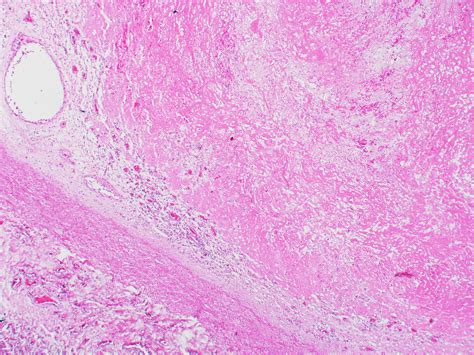 Organizing Thromboembolus In A Large Elastic Pulmonary Artery A Photo On Flickriver