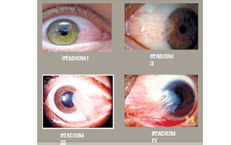 Iqro Diagnosis Banding Mata Merah