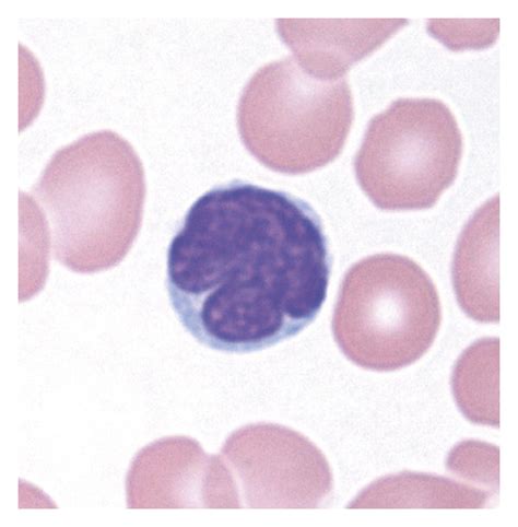 May–Giemsa staining of a blood smear showing abnormal cells with ...