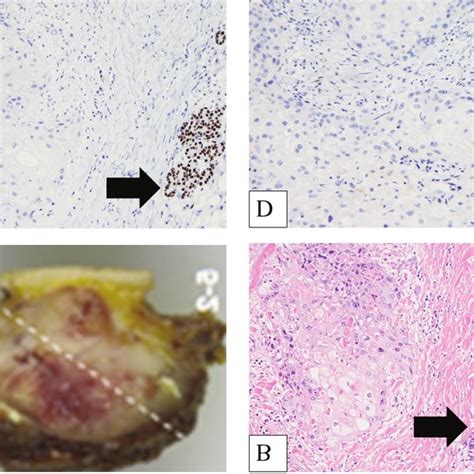 Images From The Resected Parotid Tumor A The Surgical Specimen B