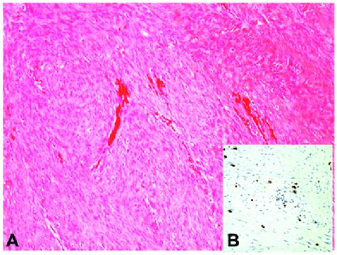 A Cellular Proliferation Of Bland Spindle Cells Arranged In Long