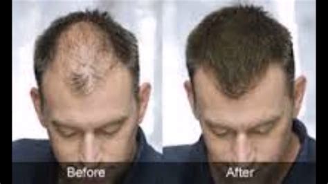 Seborrheic Dermatitis Hair Loss | Galhairs