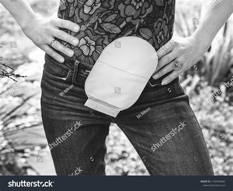 Front View On Colostomy Pouch Skin Stock Photo Shutterstock