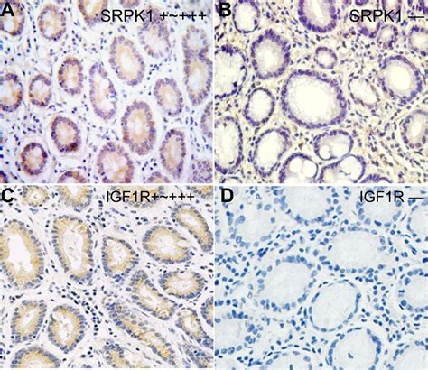 Expression Status Of SRPK1 And IGF1R Protein In Gastric Cancer Tissues