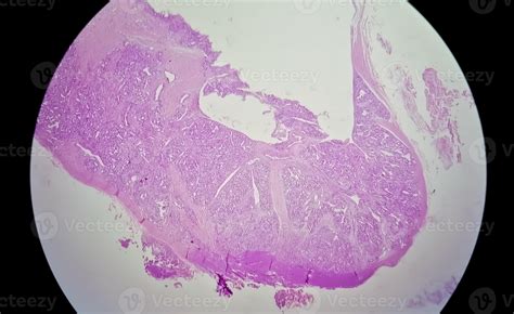 Photomicrograph of histological slide showing Lobular capillary hemangioma on finger. 43292146 ...