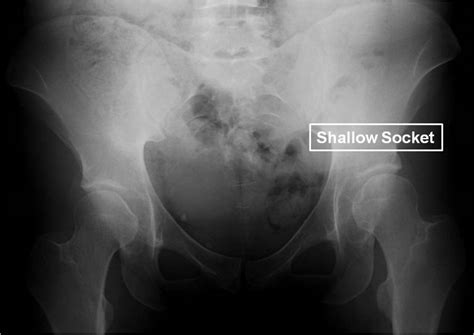 PAO surgery to treat a 29 year old female with hip dysplasia and a ...