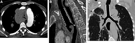 Iatrogenic Tracheoesophageal Fistula Journal Of Thoracic Oncology