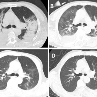 Serial Chest Computed Tomography CT Scans Of A 49 Year Old Woman With