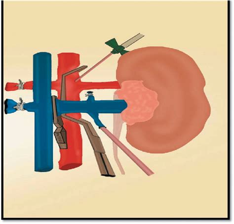 Model Of Renal Ischaemia With Local Perfusion The Stansky Clamp