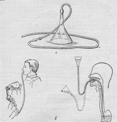 Кормление пациента через назогастральный зонд противопоказания