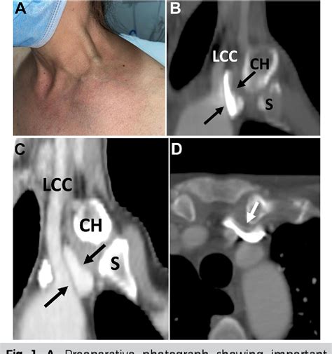 Figure 1 from Stenting of innominate vein compression syndrome ...