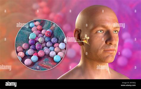 Otitis Media Ohr Infektion Durch Staphylococcus Aureus Bakterien