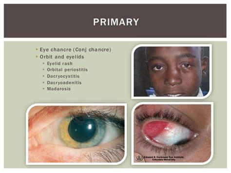 Ocular manifestations of syphilis