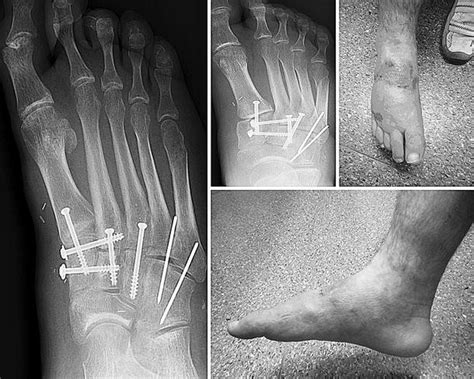 Primary Internal Fixation And Soft Tissue Reconstruction In The