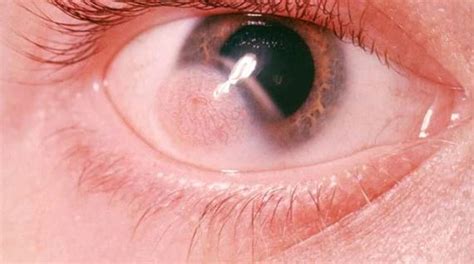 Cyst On Eyeball Inside Behind Causes Pictures Dermoid Small Clear