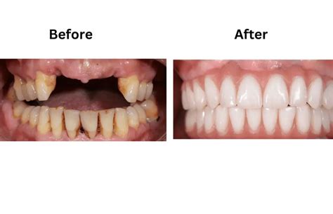 Dental Bridge Front Teeth Before and After Pictures - Complete Detail ...