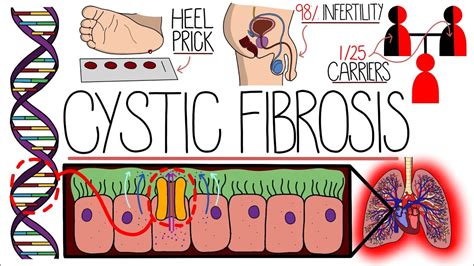 Understanding Cystic Fibrosis Includes Pathophysiology And Diagnosis Youtube