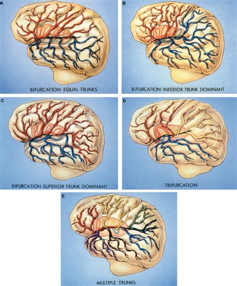 Branching Patterns of the Middle Cerebral Artery | Neuroanatomy | The ...