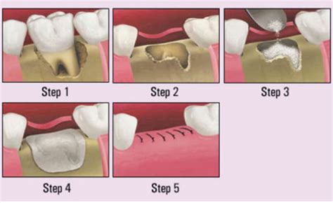 Bone Graft -Bronte Village Dental is your one stop for your dental needs