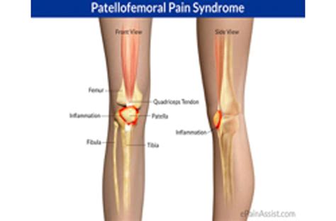 Pfps Patellofemoral