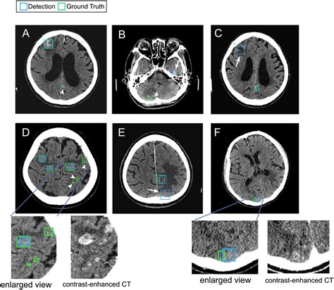 Examples Of True Positive False Positive And False Negative Lesions