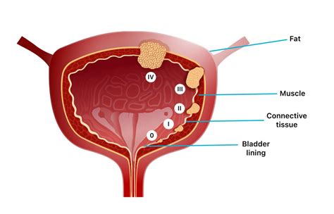 Understanding Bladder Tumor Symptoms and Treatments