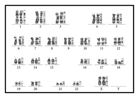 Karyogram Showing 46 Xx Deletion Of 18 P11 1 Karyotype Download Scientific Diagram