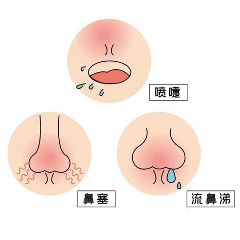 过敏性鼻炎or感冒，别再傻傻分不清了！ 知乎