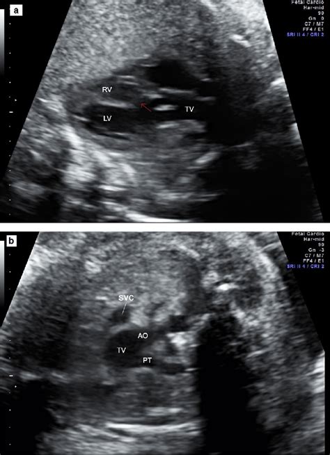 Fetal Echocardiography Showing A Case Of Truncus Arteriosus Type I A