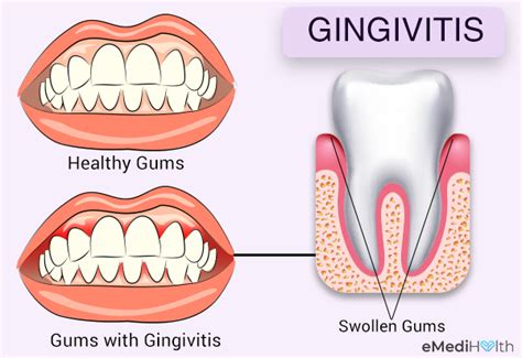 Gingivitis 101: Types, Causes, Treatment, and Risk Factors