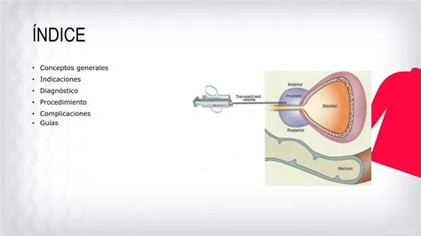 Biopsia De Próstata Transperineal Bpt Ppt