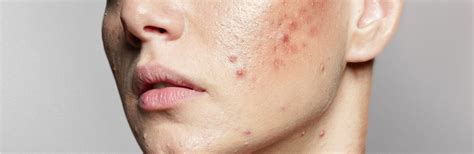 Pustular Acne Treatment In Gainesville, FL