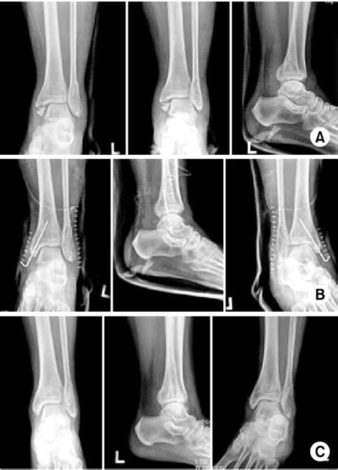 A A Year Old Woman Had A Trimalleolar Fracture Of The Ankle Joint