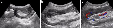 Ultrasonography Demonstrated An Ileoileal Intussusception With The Download Scientific Diagram