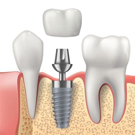 A Brief History Of Dental Implants