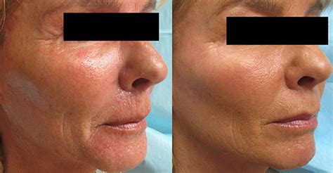 Forma Rf Skin Tightening Renew