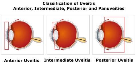 Uveitis Diagram