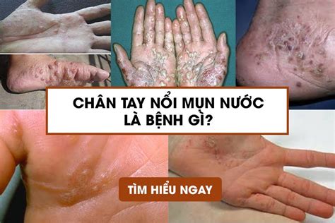 Chân tay bị nổi mụn nước và ngứa là bệnh gì Cách trị bệnh dứt điểm