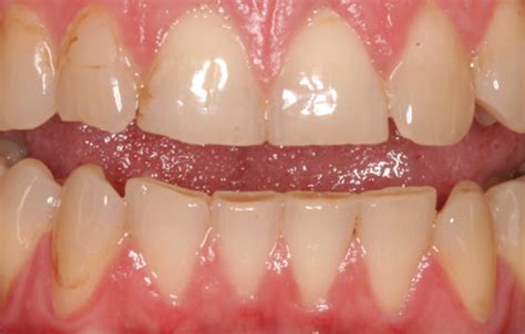 front teeth  wearing