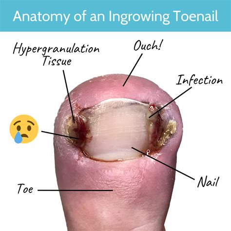 Let’s talk about ingrown nails… — Ratna Podiatry