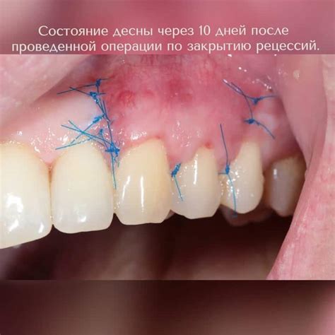 Стоит ли мириться с оголением корней зубов? | Стоматология «Артес»