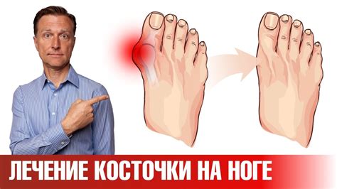 Эти 5 упражнений помогут убрать косточку на большом пальце ноги - YouTube