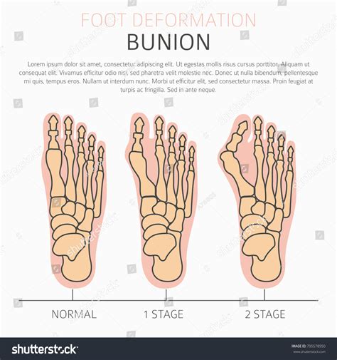 Foot Deformation Medical Desease Infographic Causes Stock Vector