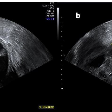 Cervical cancer Stage IIA2. Sagittal T2-weighted image showing a... | Download Scientific Diagram