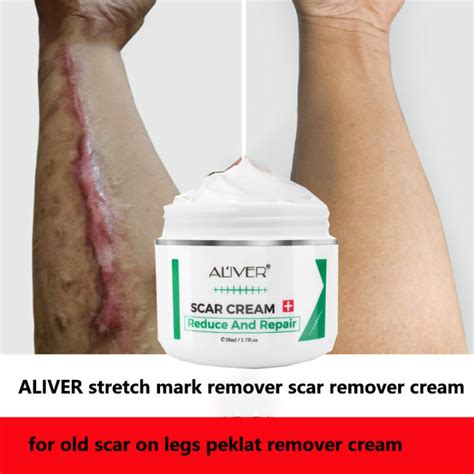 Aliver Scar Remover For Old Scar On Leg Stretch Mark Remover Acne Scar